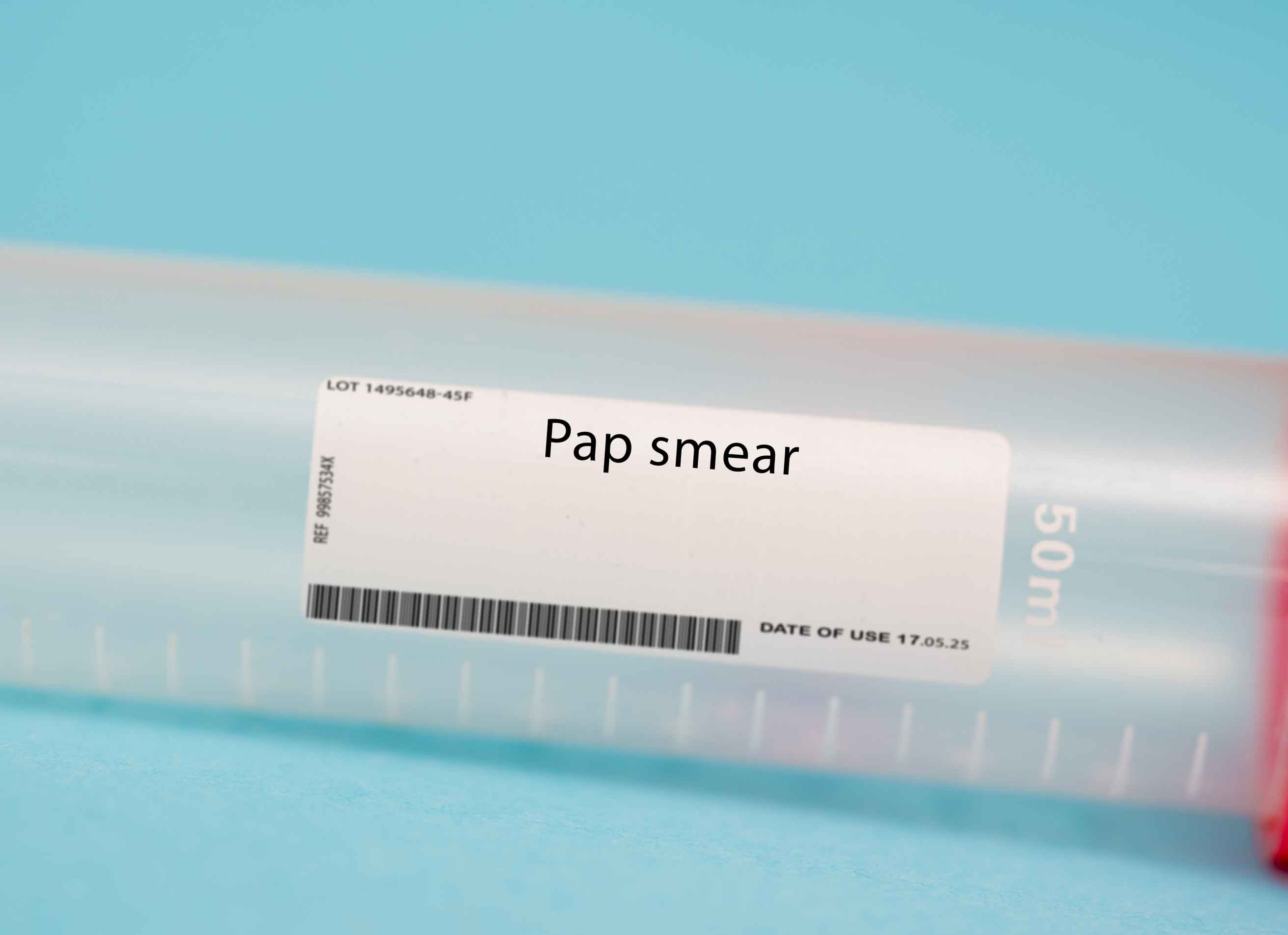 Pap,Smear.,A,Pap,Smear,,Also,Known,As,A,Pap
