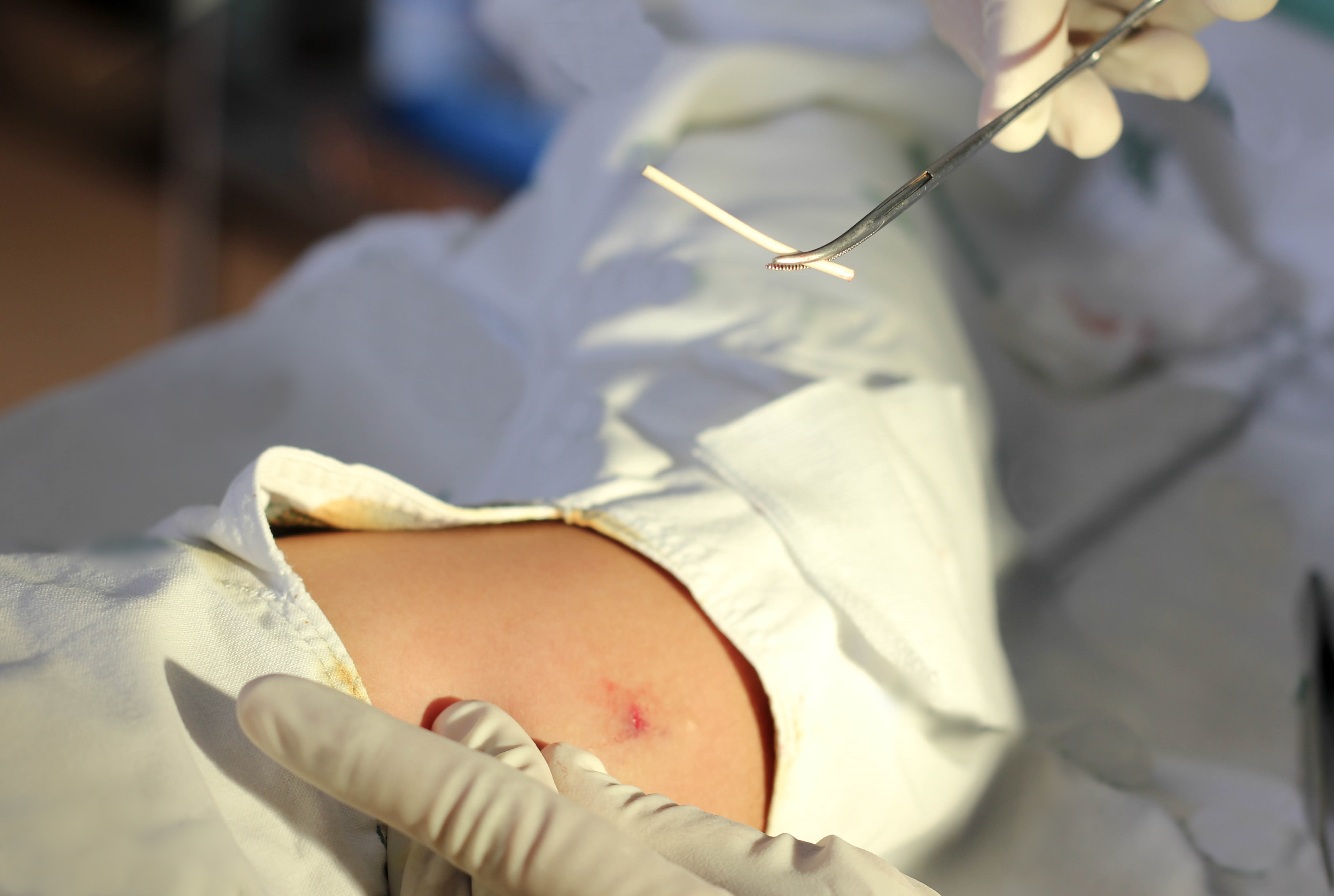 Doctor,Try,To,Remove,Contraceptive,Implant,On,Woman,Arm,,