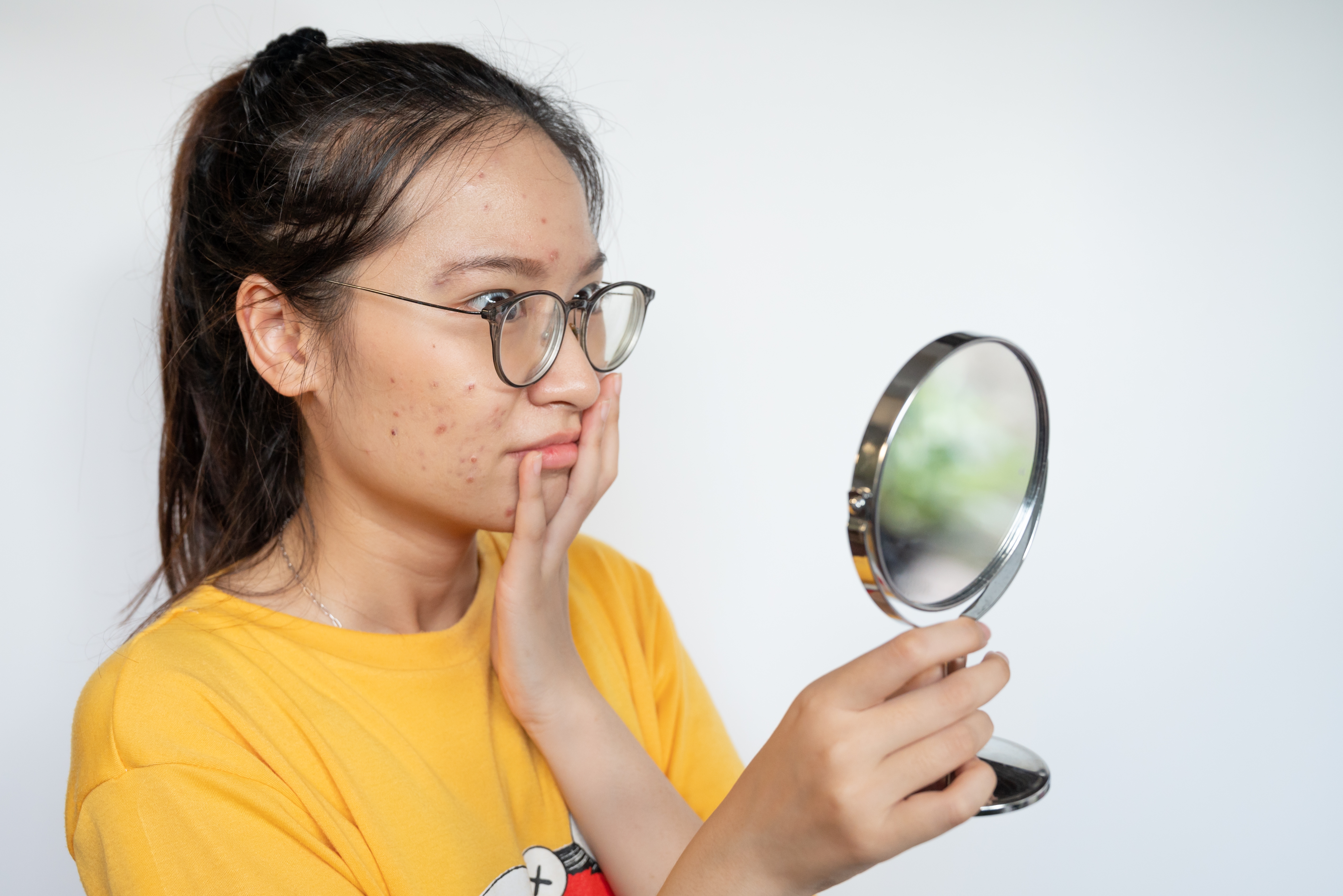 Young,Asian,Woman,Feeling,Shock,While,Looking,Acne,And,Scar